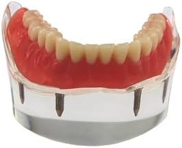 Dental Implant Teeth Demo Model Mandibular Overdenture with 4 Implants