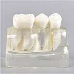 Standard Teeth Model, Dental Crown Models, 4 Times Magnification Demonstration Dental Implant Teeth Model for Doctor-Patient Communication Planting Explanation