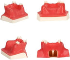 Dental Implant Training Model with Maxillary Sinus Lift Practice Realistic Simulation Jaw Cavity Lift Implant Placement Model
