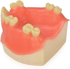Ultrassist Maxillary Dental Implant Model Missing Partial Teeth, Basic Implant Training Model with Practice Soft Gums, Great Dental Training Tooth for Dental Implant Practice