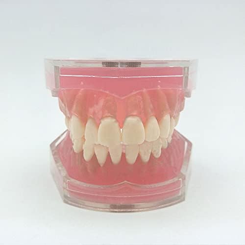 Standard Teeth Model, Dental Crown Models Soft Gums, Dental Model Resin Removable Full Mouth Teeth for Tooth Extraction Exercises, Doctor Explains to The Patient