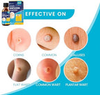 MEOLY Salicylic Wart Removal Freeze Away: Fast-Acting Wart Removal Maximum Strength for Men and Women - Plantar Wart Genital Wart Corns Calluses 30 ML