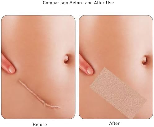 Tattoo Cover up Patch 10PCS,Waterproof Sweatproof Sticker,Cover up Tape Cuttable Invisible Scar Birthmarks Sticker (light skin color)