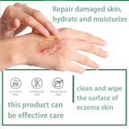 Aacnre Ecz𝗲ma Th𝗲𝗿apy Spray, Effective 7-Day Moisturizing Hand Cream Body Spray, An𝘁𝗶b𝗮c𝘁erial Natural Soothing P𝘀𝗼𝗿i𝗮𝘀is Crema, Ointment for Natural Relief of Skin Problems