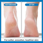 6 Pieces Pumice Stone Foot File Scrubber Pedicure Callus Remover Tool Set Foot Care Kit(Blue)