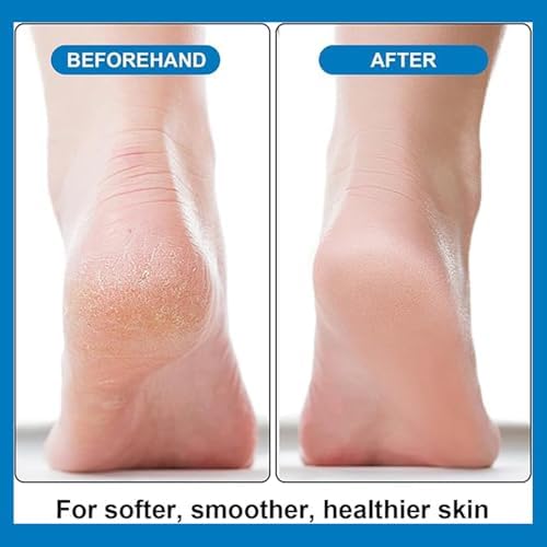 6 Pieces Pumice Stone Foot File Scrubber Pedicure Callus Remover Tool Set Foot Care Kit(Blue)