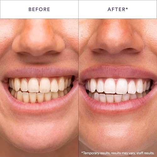 Hismile V34 Whitening Strips, Teeth Whitening Strips, Purple Tooth Whitening, Purple Whitening Strips, Tooth Stain Treatment, Combining Whitening and Colour Correction