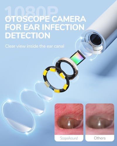 ScopeAround Otoscope with Light, 1080P FHD Ear Scope, 3.9mm Digital Otoscope Camera with 6 LED Lights Ear Wax Removal Tool Camera, Ear Scope with Light, Compatible with USB-C