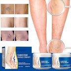 Varicose Veins Treatment Cream for Legs Natural Ingredients, Suitable for Most Skin Types