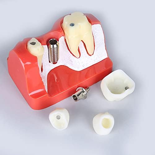 Standard Teeth Model, Dental Crown Models, 4 Times Magnification Demonstration Dental Implant Teeth Model for Doctor-Patient Communication Planting Explanation