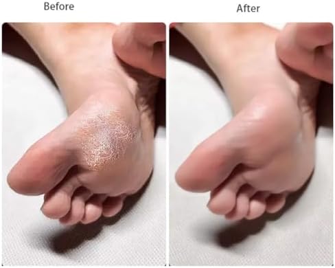 4 Pack Double Sided Foot File Callus Remover Pedicure Tool Dead Skin Scrubber Heel Exfoliator Foot Rasp Hard Skin Remover Plastic Sandpaper Foot Care Tool