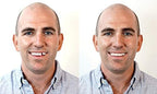Instant Smile Triple Shade Temporary Tooth Kit - Replace A Missing Tooth in Just 5 Minutes!