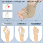2PCS Bunion Corrector for Women & Men, Big Toe Straightener with Splint & Pads, Comfortable & Breathable for Day/Night Support, Hallux Valgus Pain Relief Non-Slip Socks (1, Beige)