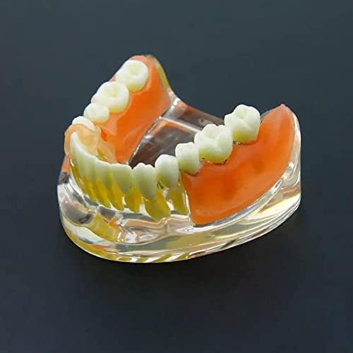 Teaching Model,Dental Implant and Restoration Model, Silicon Rubber Dental Teeth Model Inferior Removable Restoration Implant Bridge Demo Model for Teaching and Studying