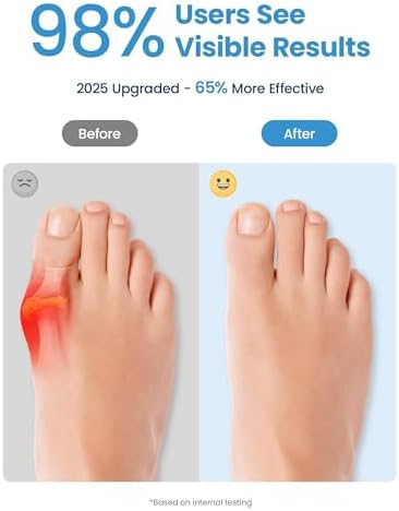 Bunion Corrector, Toe Separators for Women Men Big Toe, Toe Spacers, Bunion Correction, Breathable(2PCS)