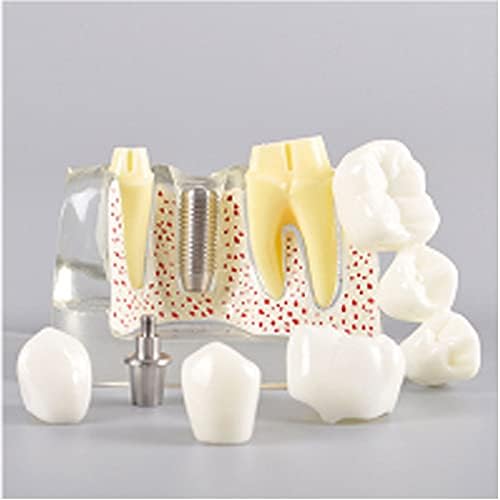 Standard Teeth Model, Dental Crown Models, 4 Times Magnification Demonstration Dental Implant Teeth Model for Doctor-Patient Communication Planting Explanation