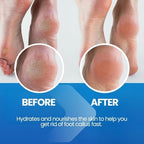 Imperial Feet Callus Softener Spray for Feet Extra Strength – Callus Remover for Feet & Toes, Hard Skin Remover for Dry Cracked Heels, Foot Dead Skin Remover for Pedicure & Foot Care
