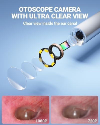 ScopeAround Otoscope with 4.5" IPS Screen, 3.9mm Ear Camera with Gyroscope, No App Needed Ear Wax Removal Tool with Light, 32GB Card, Easy to Use Digital Ear Scope for Safe Home Ear Checker
