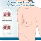 Pectus Excavatum Orthosis Brace, Pectus Excavatum Vacuum Bell， Sunken Sternum Brace for Adults and Child Physical Correction of Sunken Chest (Medium)
