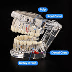 Ultrassist Transparent Dental Disease Teeth Model with Removable Teeth, Dental Pathology Demonstration Model for Dentist Patient Education & Teaching
