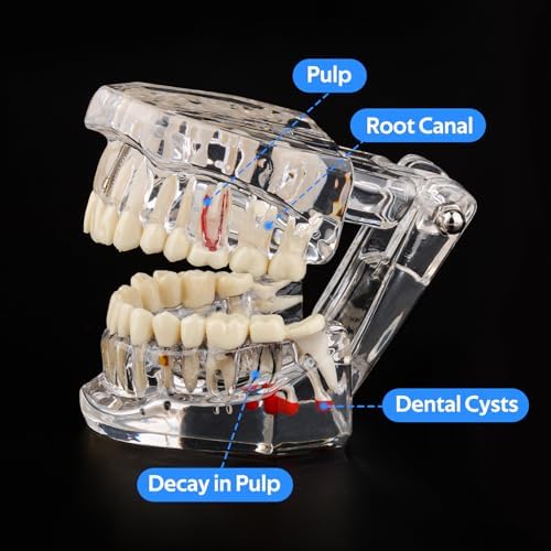 Ultrassist Transparent Dental Disease Teeth Model with Removable Teeth, Dental Pathology Demonstration Model for Dentist Patient Education & Teaching