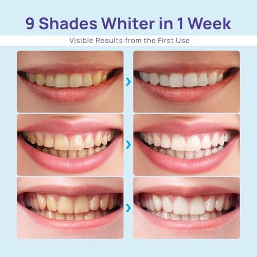 Whitebite Pro Teeth Whitening Kit for Sensitive Teeth – 32X LED Light + 35% Carbamide Peroxide Gel + Remineralizing Gel | Dental-Grade Whitening at Home Flavor Mint