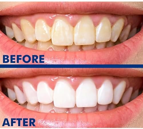 Teeth Whitening Pen (4 Pack), No Sensitivity Teeth Whitening Gel, Best Teeth Whitening Pen, Removes Stains, Effective, Enamel Safe, Fast Results, Travel Friendly, Natural Mint Flavor