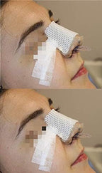 Thermoplastic Nasal Splints, External Nose Support Protector for Rhinoplasty Septoplasty Surgery, Nose Brace Fracture, ENT, Orthopedic Immobilization, 50 pcs-L Size (B)