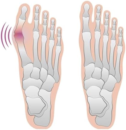 4 Bunion Relief Pads and Sleeves, Orthopedic Bunion Corrector Socks with Gel Pads, 2 Pairs