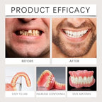 Silicone Full Denture Set, Moldable Dentures, Premium Dentures, Silicone Reline Denture Set, Denture Silicone Reline Kit (1)
