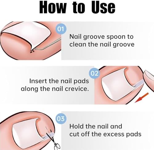 50 Pcs Ingrown Toenail Corrector Set, Toenail Correction Strips Brace Kit, Ingrown Toenails Correction Pad Recover Clips, Toenails Straightener Strips for Women Men's Nail Treatment Pedicure