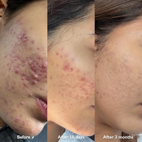 ORBE Derma Solutions Orbe it! 2-Step Acne Treatment w/ Salicylic Acid for Face & Body – Helps Unclog Pores & Reduce Pimples, Back Acne, Ingrown Hairs, Razor Bumps, Folliculitis – Spray 1oz & Cream 1oz