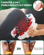 ONUEMP Cellulite Remover for Legs, Cellulite Massager Roller Muscle Roller, Fascia Massage Tool Thigh, Calf, Leg Massager - Anti-Celulitis, Lymphatic Drainage, Body Sculpting, Deep Tissue Pain Relief