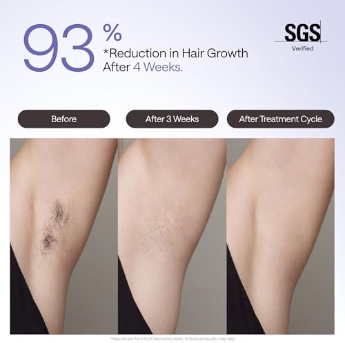 Ulike Laser Hair Removal Device Air 4 Ipl Gift for Women and Men, Ice Cool and Permanent Hair Reduction for Nearly Painless, USHR Mode Hair Removal in 10mins from Home