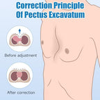 Pectus Excavatum Brace Pectus Excavatum Vacuum Bell Pectus Excavatum Orthosis Sternum Brace Chest Brace for Kids Men Women (Small)