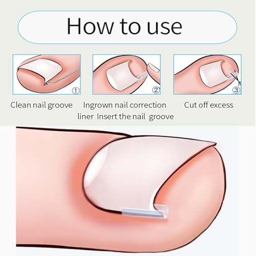10Pcs Ingrown Toenail Correction Strips Brace Kit, Toenail Straightener Tool for Thick Toenails, Pedicure Foot Care for Men and Women