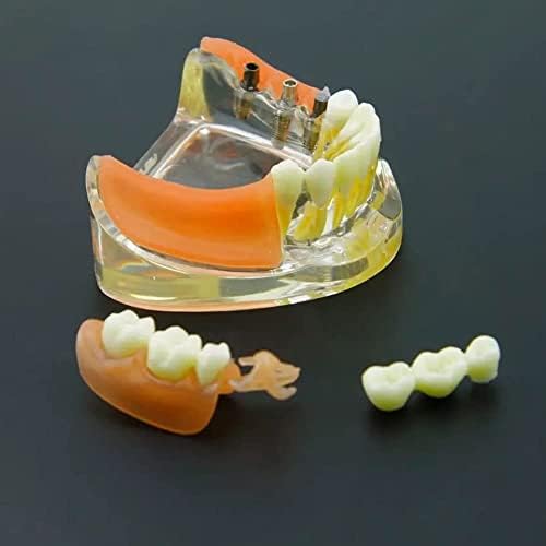 Teaching Model,Dental Implant and Restoration Model, Silicon Rubber Dental Teeth Model Inferior Removable Restoration Implant Bridge Demo Model for Teaching and Studying