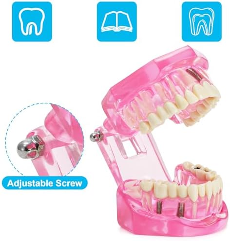 ZENFUN Disease Teeth Model with Dental Implant Bridge, Dental Model for Patient and Dental Student Education, Teeth Typodonts Analysis Demonstration Teeth Model Standard Size (Pink)