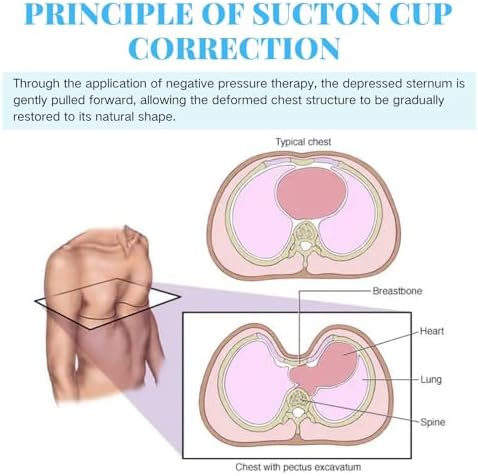 Pectus Excavatum Orthosis Brace with Automatic Air Pump, Pectus Excavatum Vacuum Bell for Sunken Chest, Thoracic Depression Support, Sternal Depression Support for All Ages (Medium)