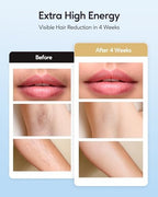 INNZA IPL Hair Removal with Ice Cooling Care Function for Women,Long-Lasting Results,999,999 Flashes Painless Hair Removal, Hair Removal Device for Armpits Legs Arms Bikini Line,Corded
