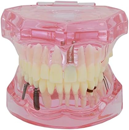 Teeth Model Teeth Typodonts Dental Implant Study Analysis Demonstration Teeth Model #2001 with Restoration Pink
