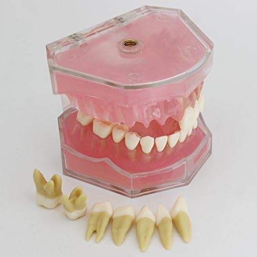 Dental Implant Teeth Model with Removable Teeth for Dental Professionals and Students