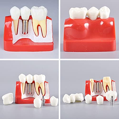 Standard Teeth Model, Dental Crown Models, 4 Times Magnification Demonstration Dental Implant Teeth Model for Doctor-Patient Communication Planting Explanation