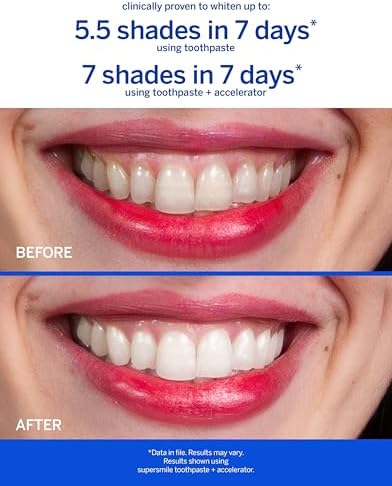 Supersmile Fluoride-Free Whitening System Gift Set with Travel Bag – 2 Calprox® Toothpastes, Accelerators & New Generation Toothbrushes – No Sensitivity, Whitens Up to 6 Shades & Strengthens Enamel
