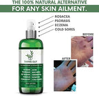 Thyme Out All Natural Eczema Treatment- Psoriasis Treatment - an All-in-One Solution for Acne, Dermatitis, Rosacea, Cold Sores, Bites, Poison Ivy - Anti-Itch Spray for Itchy Skin Relief 4oz