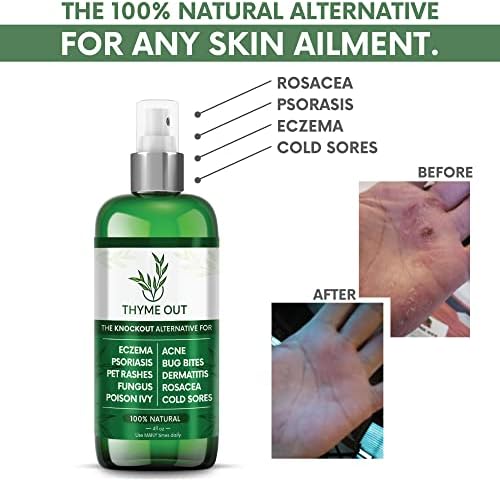 Thyme Out All Natural Eczema Treatment- Psoriasis Treatment - an All-in-One Solution for Acne, Dermatitis, Rosacea, Cold Sores, Bites, Poison Ivy - Anti-Itch Spray for Itchy Skin Relief 4oz