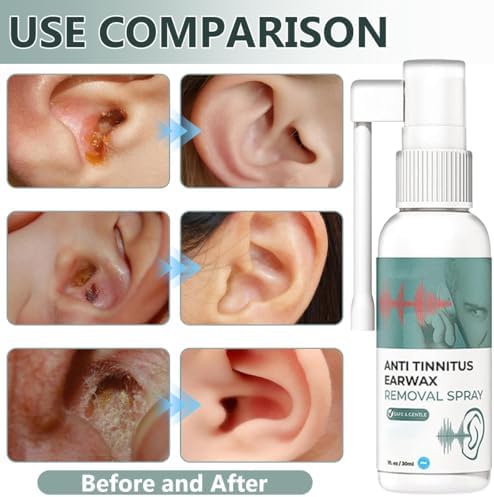 Hearing Restoration Spray, Anti Tinnitus Earwax Removal Spray, Earwax Cleaning Spray, Tinnitus Spray for Ear (2PCS)