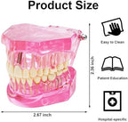 ZENFUN Disease Teeth Model with Dental Implant Bridge, Dental Model for Patient and Dental Student Education, Teeth Typodonts Analysis Demonstration Teeth Model Standard Size (Pink)