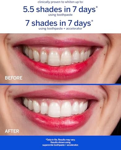 Supersmile Professional Teeth Whitening Toothpaste - Fluoride Free for Visibly Brighter Smile - Whitens up to 6 Shades