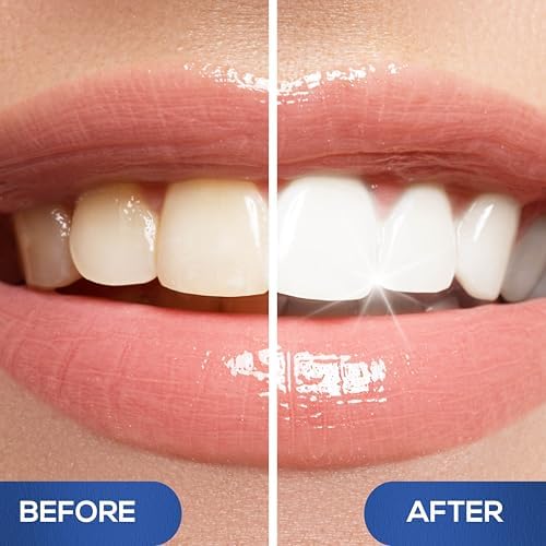 Venus Visage Award Winning Teeth Whitening Pen, 20+ Uses - Teeth whitening Kit Professionally formulated - Best Teeth whitening Gel Pen Teeth Whitener - Low Sensitivity (Mint) (0.07 Fl Oz (Pack of 2))